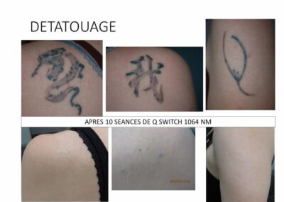 Détatouage Q Switch 10 séances