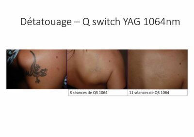 Détatouage Q Switch YAG 11 séances