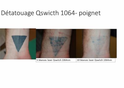 Détatouage poignet Q Switch 10 séances