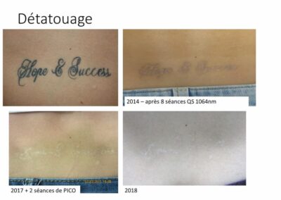 Détatouage dos Q Switch 10 séances