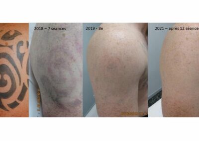 Détatouage épaule 12 séances