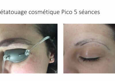 Détatouage sourcils Pico 5 séances
