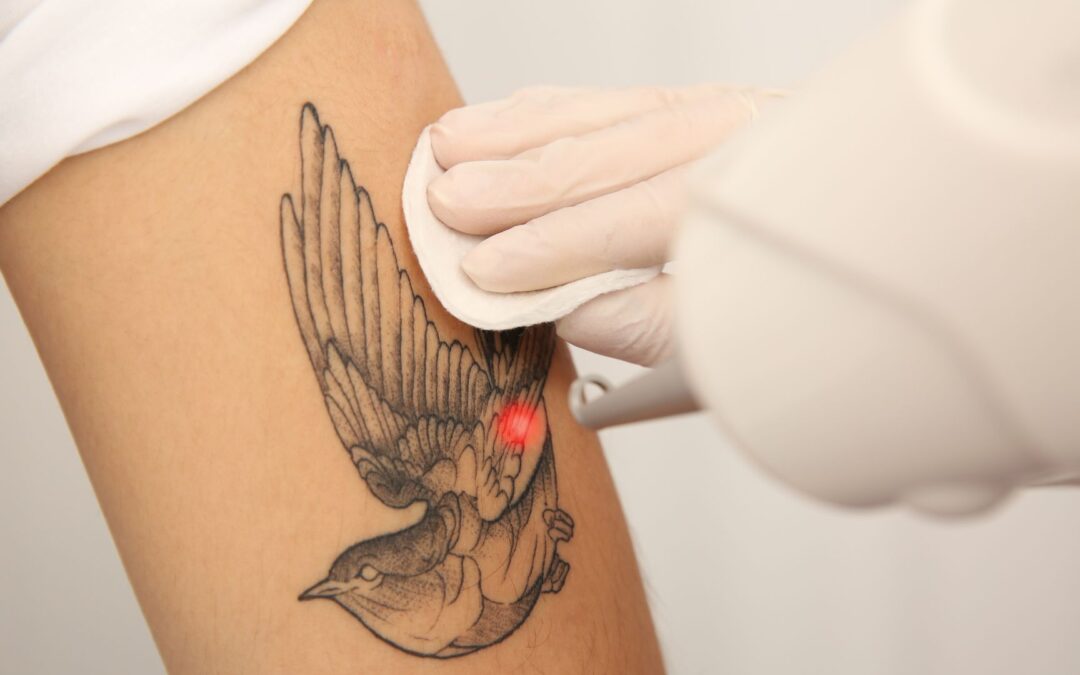 Le détatouage laser fait-il mal ?