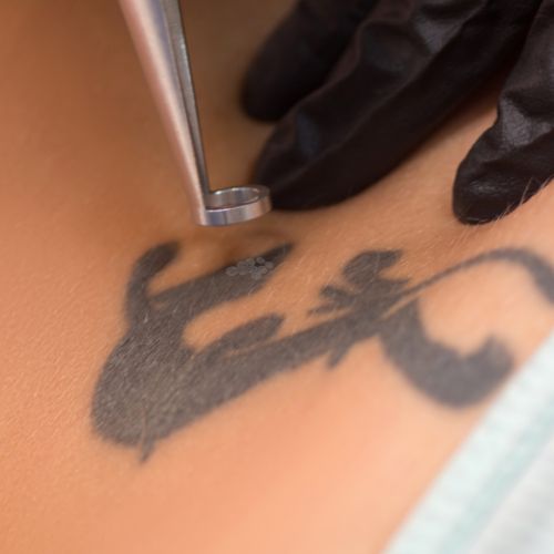 cibler l'encre du tatouage