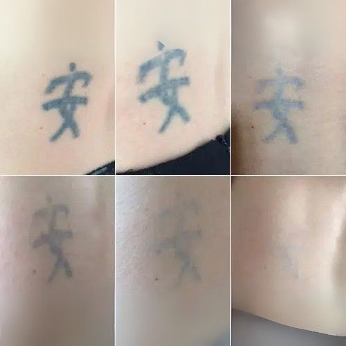 effacement tatouage lyon