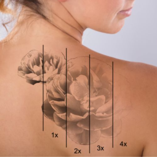 le détatouage est progressif