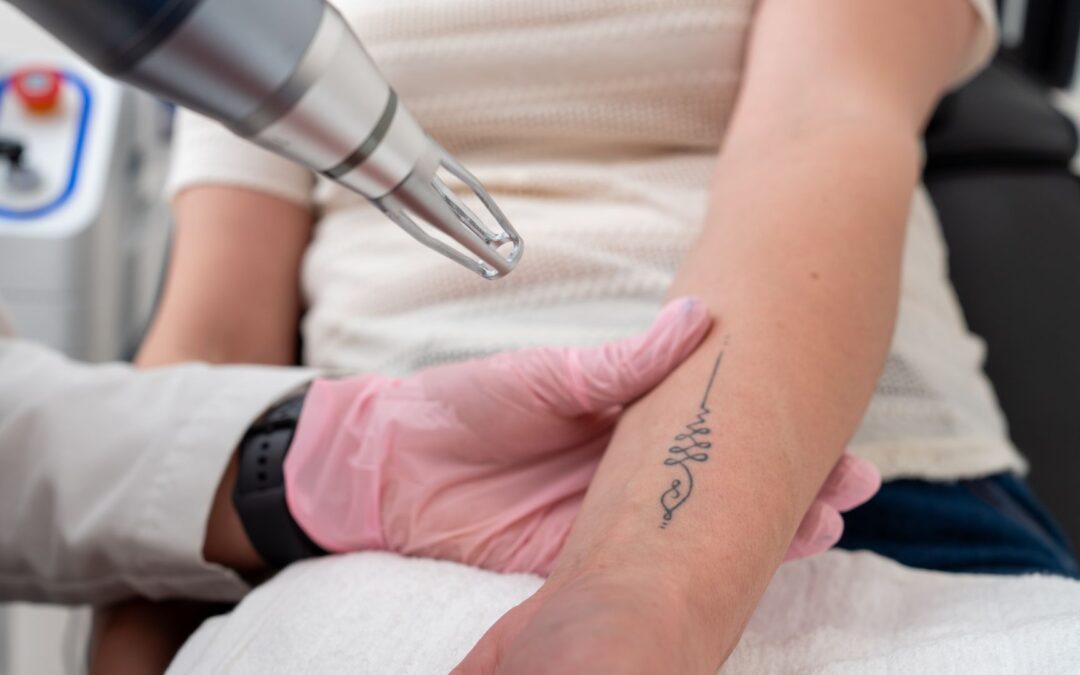 Quelle différence entre le détatouage laser PicoSure® et Q-Switched ?