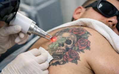 Détatouage laser : contre-indications et précautions essentielles