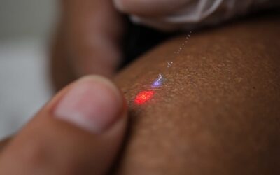 Détatouage sur peau mate ou foncée à Lyon : précautions spécifiques