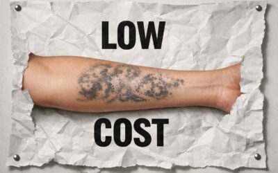 Détatouage laser pas cher à Lyon : attention danger