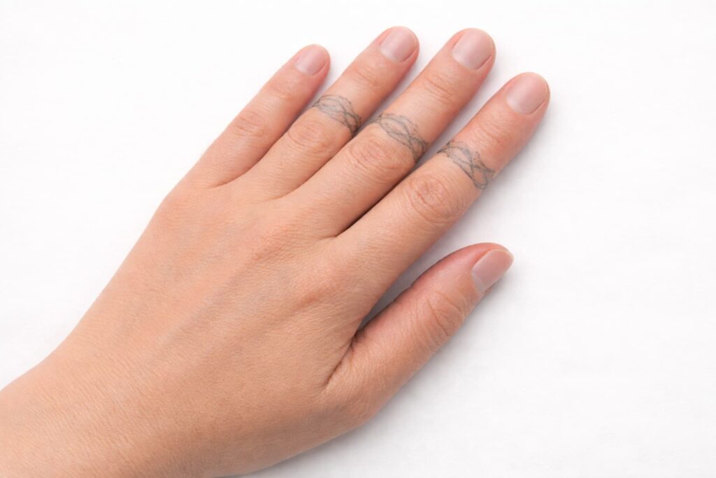detatouage laser des mains à lyon