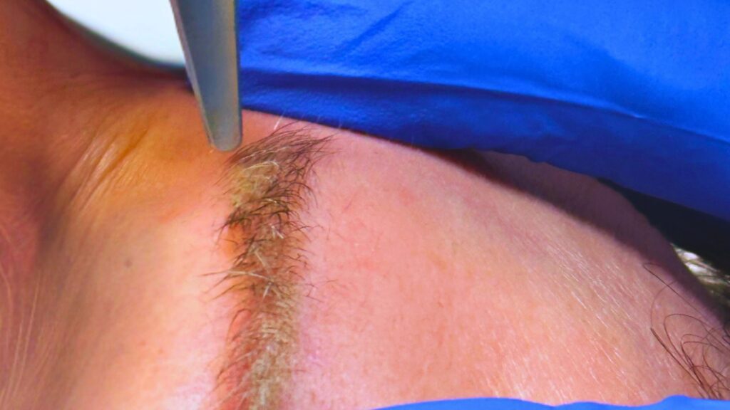 détatouage laser des sourcils à lyon (2)