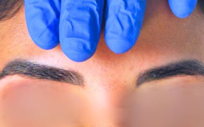 Détatouage laser des sourcils à Lyon : effacement microblading et dermopigmentation