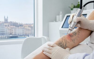 Détatouage laser : effets secondaires, quand faut-il consulter à Lyon ?