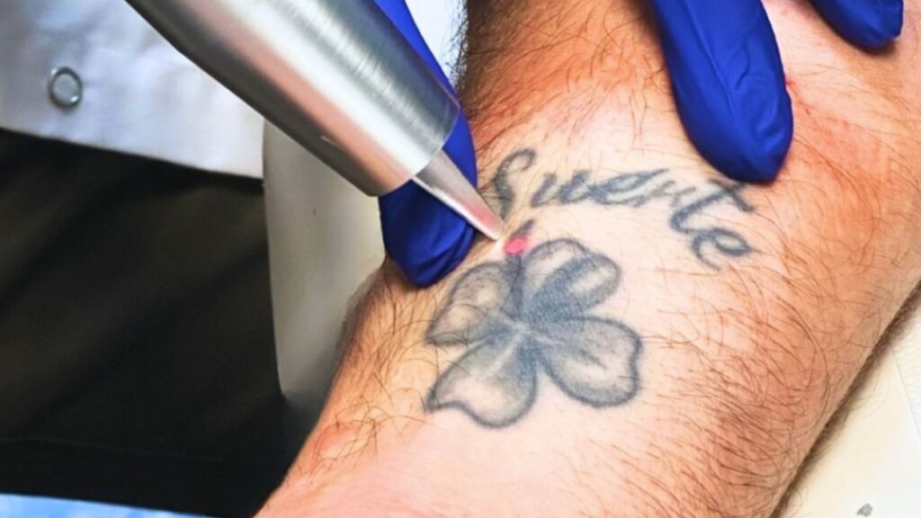 detatouage laser lyon presqu'ile