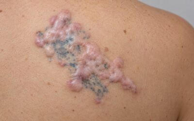Détatouage sans laser : quelles alternatives et quels risques ?