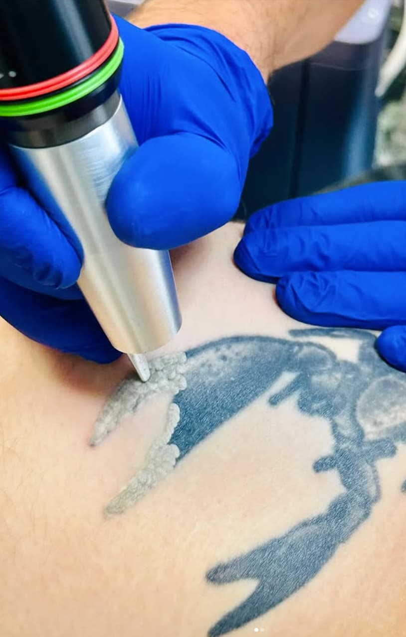 detatouage laser - venissieux