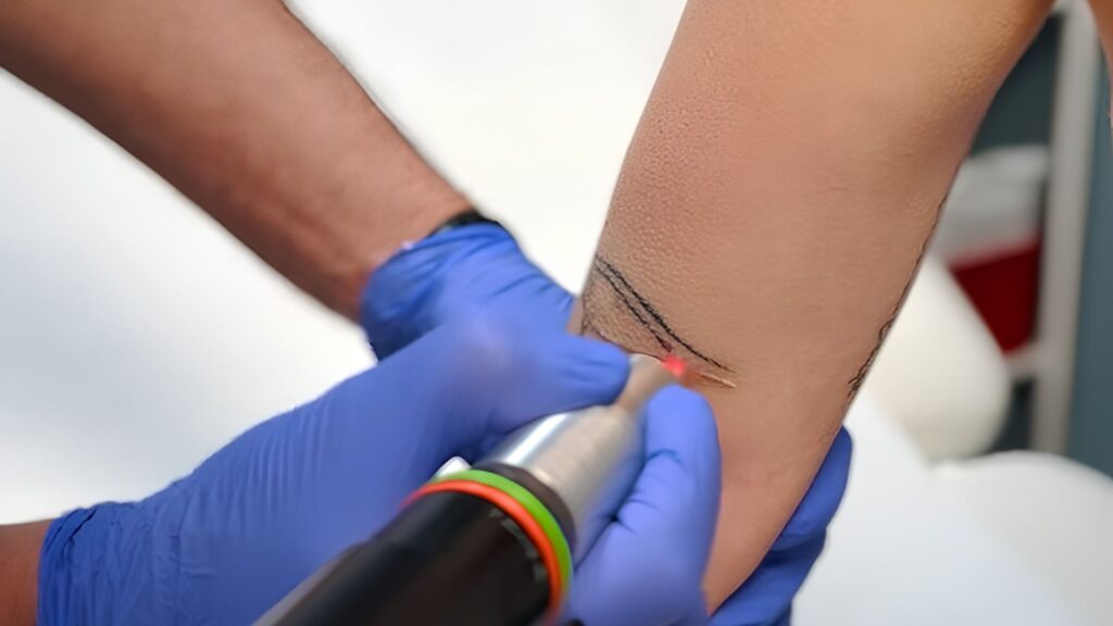 le détatouage laser est la méthode la plus sûre et la plus efficace